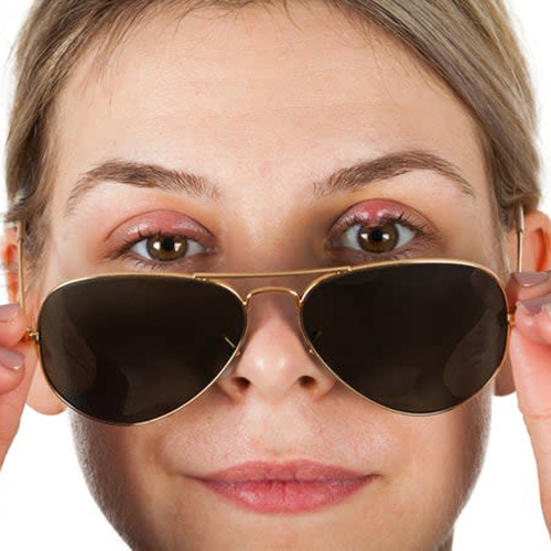 Хірургічнае лячэнне халязіёна