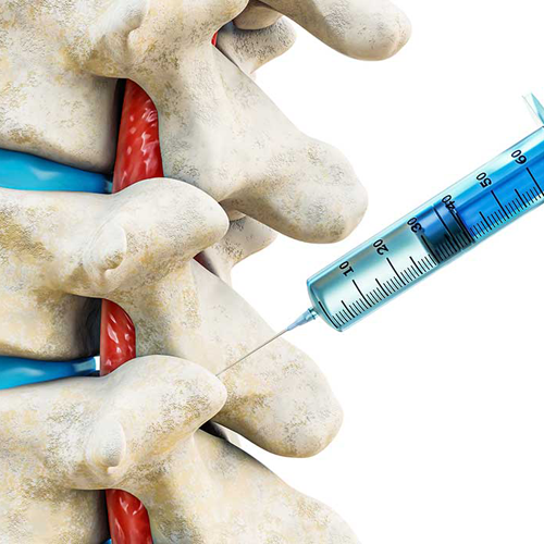 Інтэрвенцыйнае лячэнне болі ў спіне