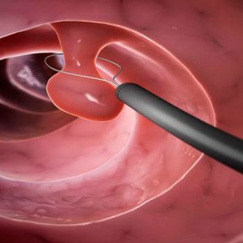 Выдаленне паліпаў цела і шыйкі маткі