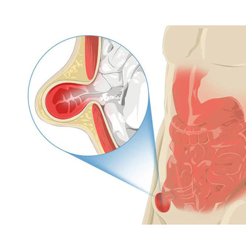 Хірургічнае лячэнне грыж