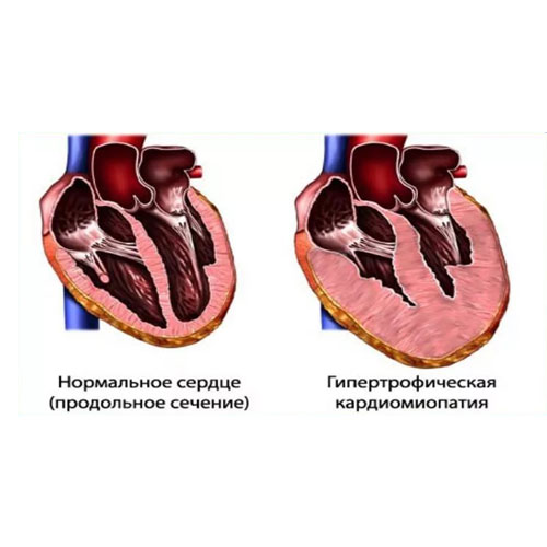 Хірургічнае лячэнне гіпертрафічнай кардыяміяпатыі (ГКМП)