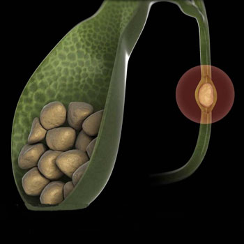 Хірургічнае лячэнне паталогій жоўцевых параток