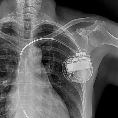 Імплантацыя штучнага кардыявертэра