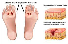 Диабетическая стопа
