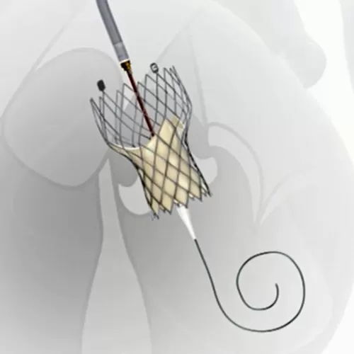 Транскатэтаральная імплантацыя аартальнага клапана TAVR