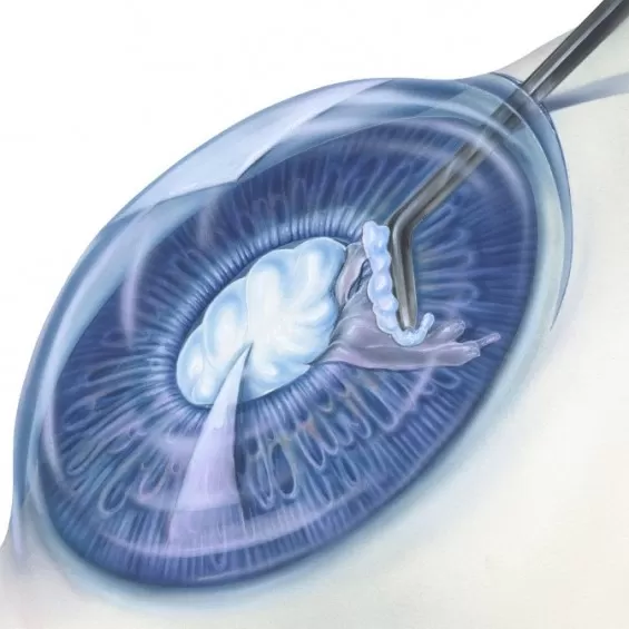 Хірургічнае лячэнне катаракты