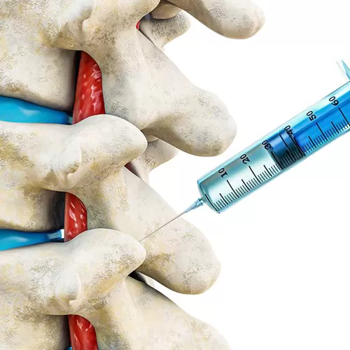 Інтэрвенцыйнае лячэнне болі ў спіне