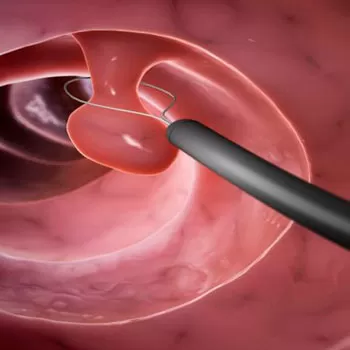 Выдаленне паліпаў цела і шыйкі маткі