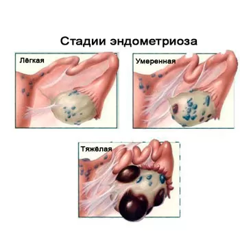 Хірургічнае лячэнне адэнаміёзу і эндаметрыёзу