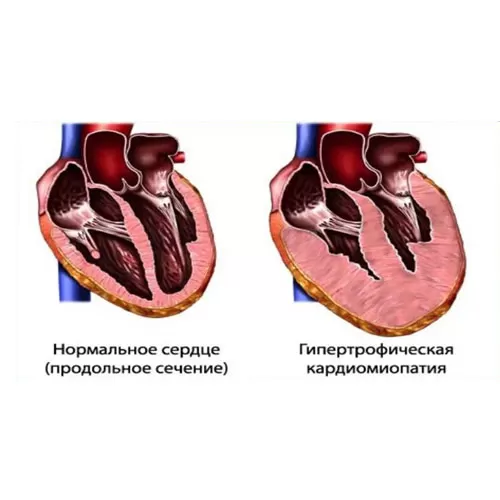 Хірургічнае лячэнне гіпертрафічнай кардыяміяпатыі (ГКМП)