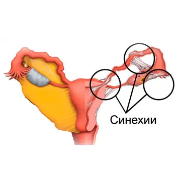Хірургічнае лячэнне ўнутрыматачных паталогій