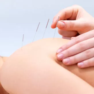 Іголкарэфлексатэрапія